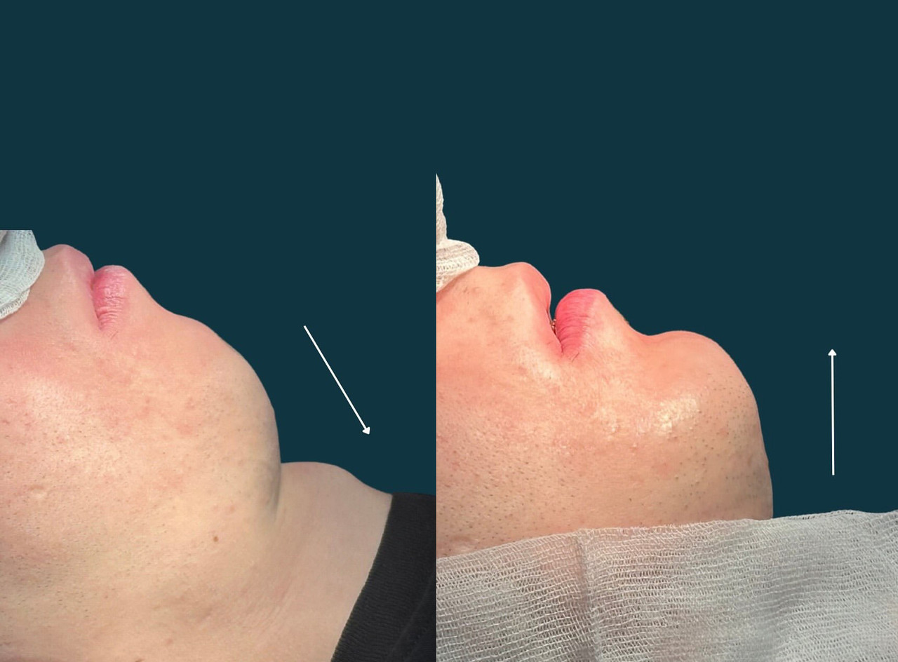 Genioplasty in Armenia Visual Guide