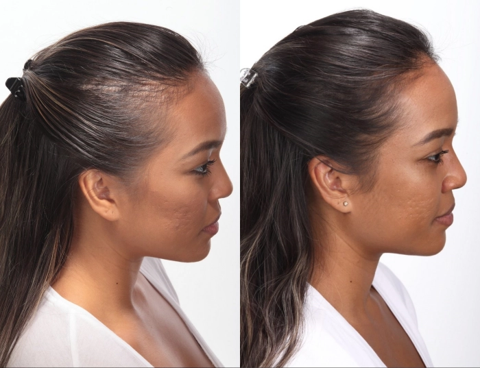 Hair growth and volume before and after