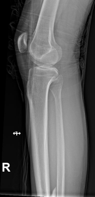 18 12 25 koleno lat d