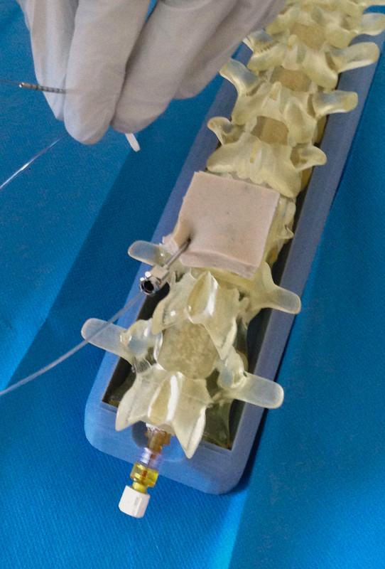3D printed spinal cord simulator developed by Enri Zhulati for validating neuromodulation surgical leads