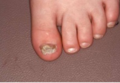 Thickened, yellow-brown, crumbly toenail with subungual debris - onychomycosis