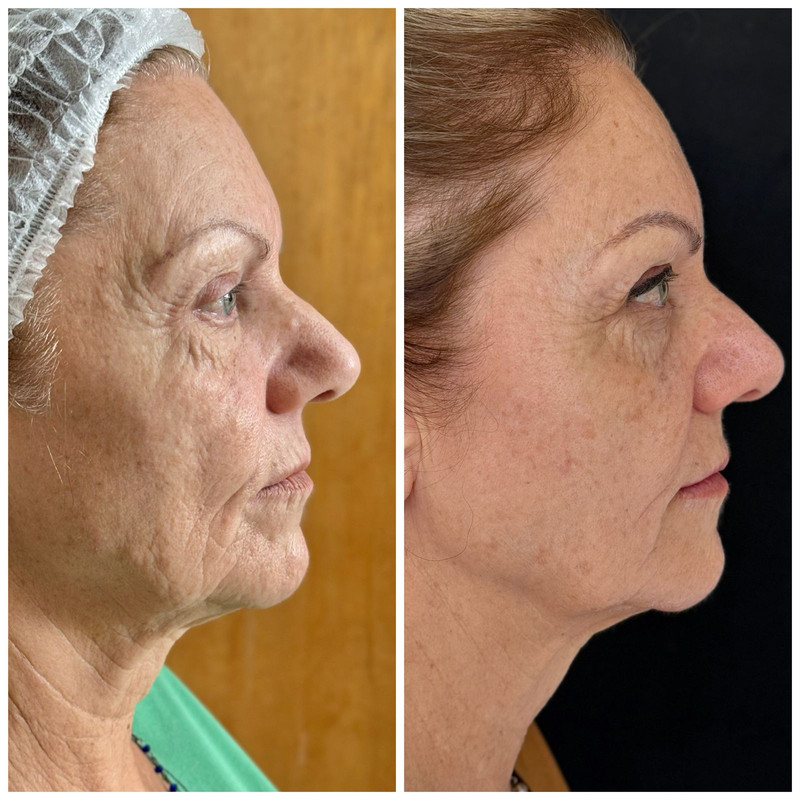 Rejuvenescimento Facial