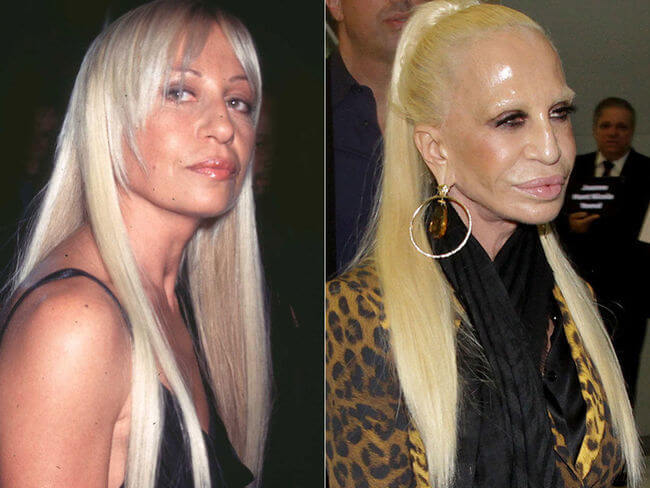 plastic-surgery-gone-wrong-7-1