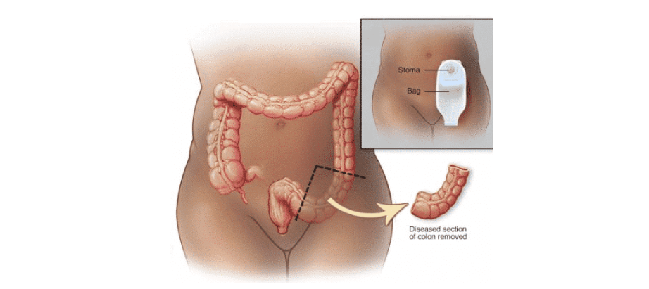 Tipos de colostomía: descendente, transversa y ascendente