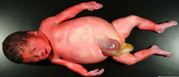 Beckwith-Wiedemann Syndrome - macroglossia, omphalocele, earlobe creases, macrosomia