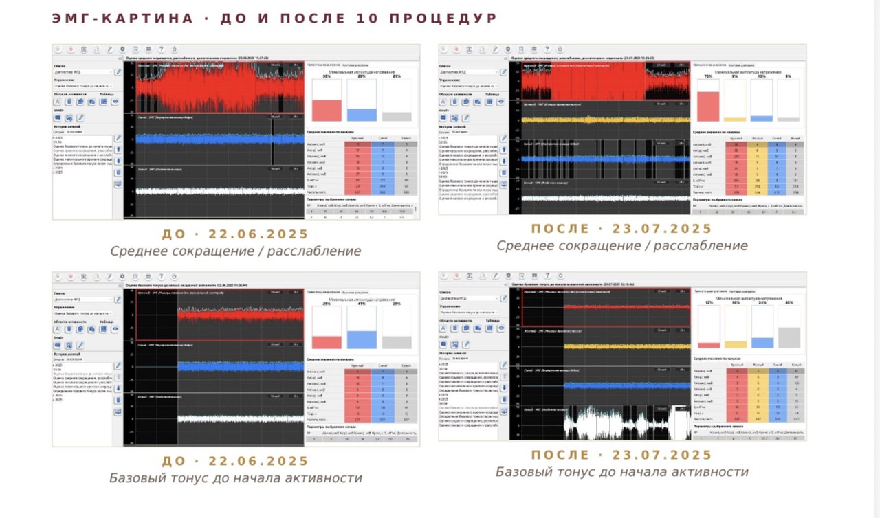Кейс 1 — ЭМГ до и после БОС-терапии