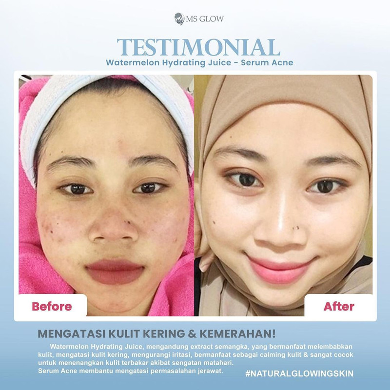 testimoni ms glow skin care