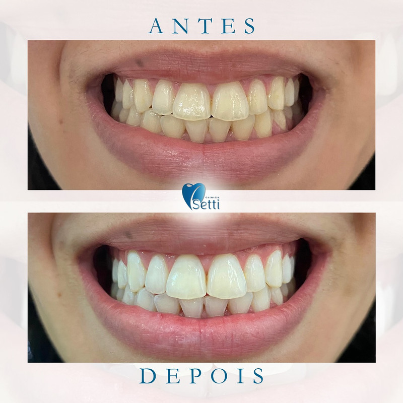 Resultado 2 - Reabilitação com Implantes Antes e Depois Integrado