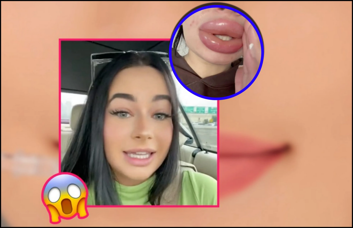 Ganó un sorteo para aumentarse los labios y el resultado se hizo viral