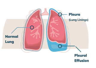 [Image: Meso-Pleural-Effusion-52-2.png]