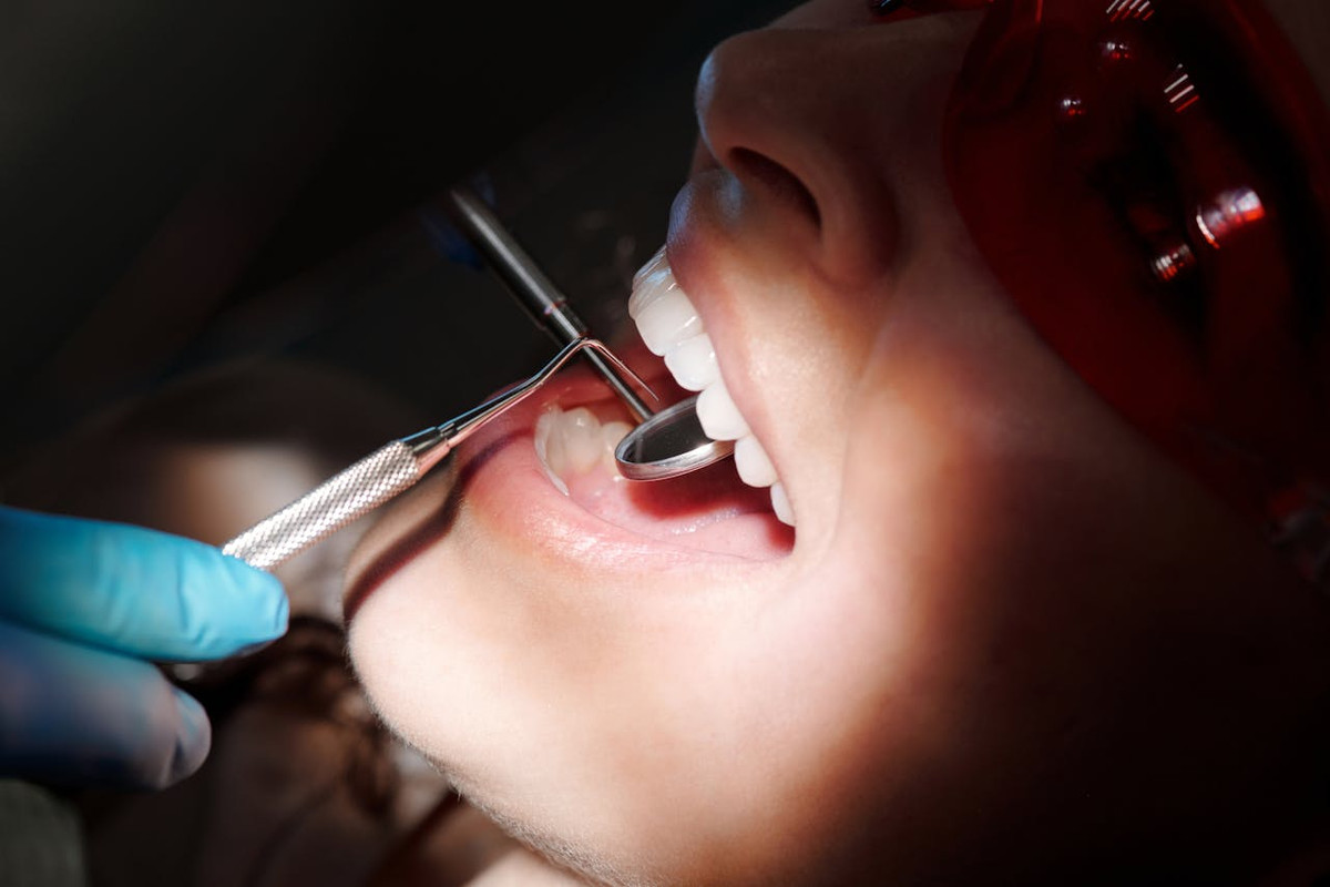 Top 5 Symptoms of Tooth Cavities