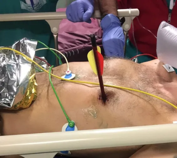 Asesinan a un hombre con una flecha, por ocasionar ruido en las calles de Italia