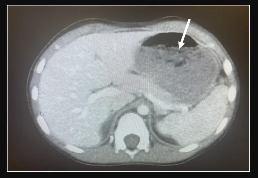 Niño de 5 años es operado de emergencia tras tragarse 40 chicles en Ohio