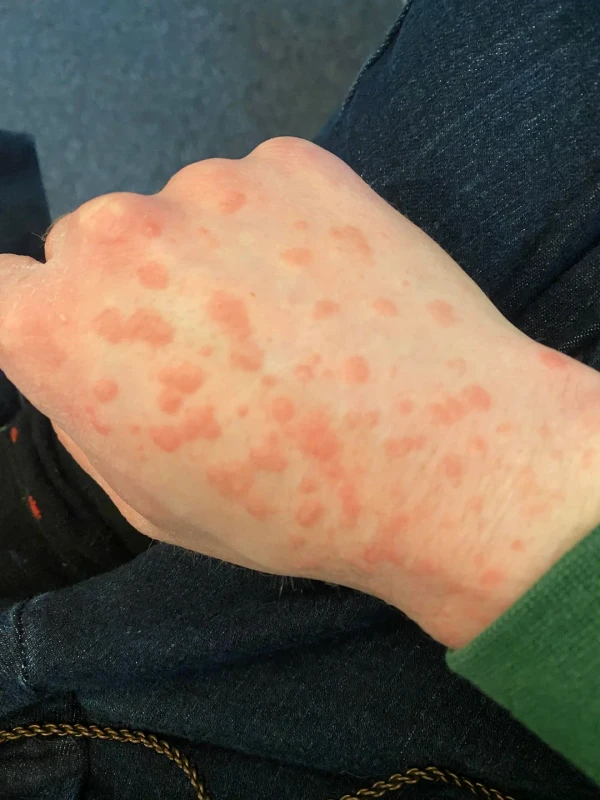 is it normal for the rash to look like this post treatment v0 7mtle92ederg1