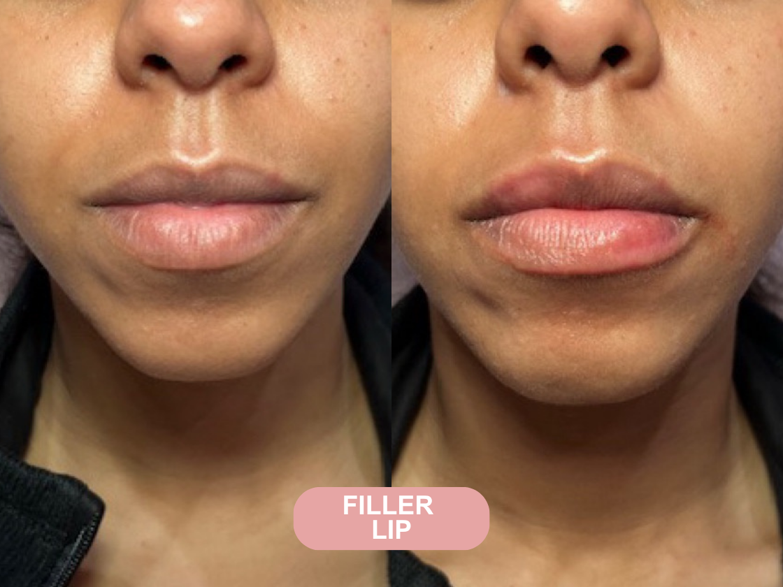 Kybella before and after results at Let's Face It Med Spa
