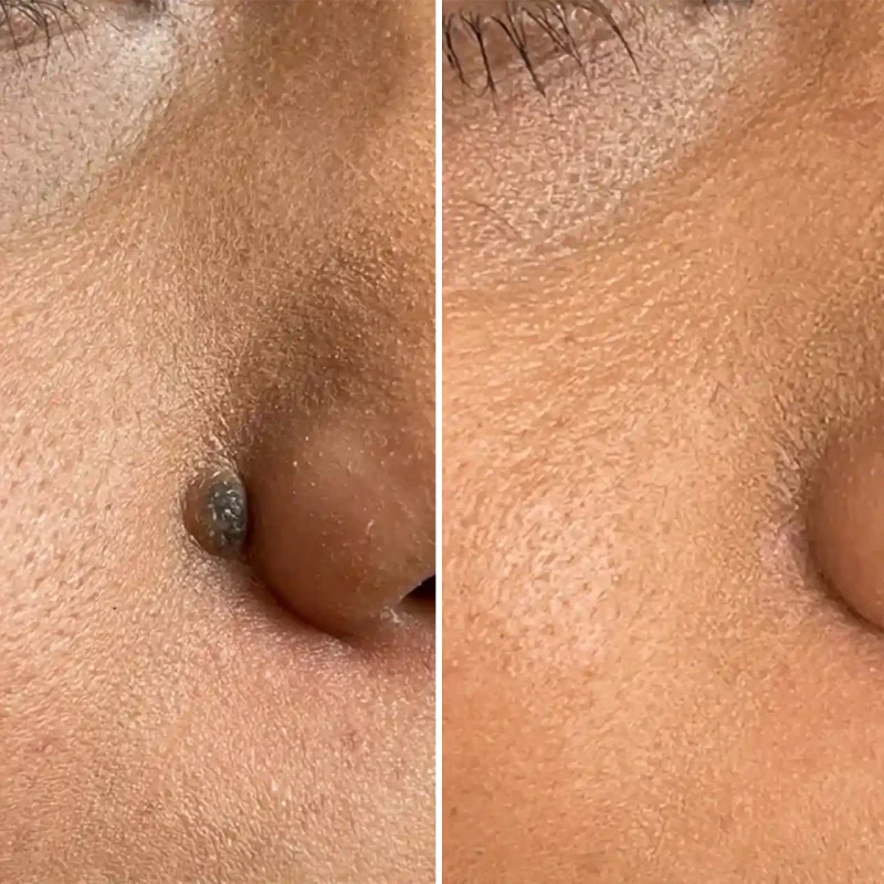 Mole Excision