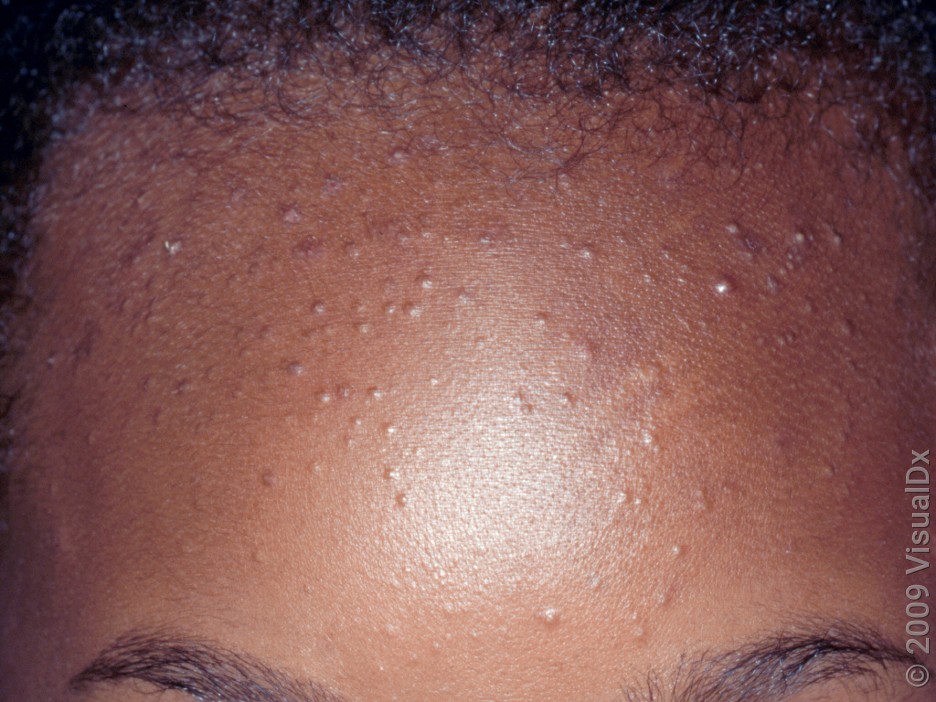 Acne types treatment