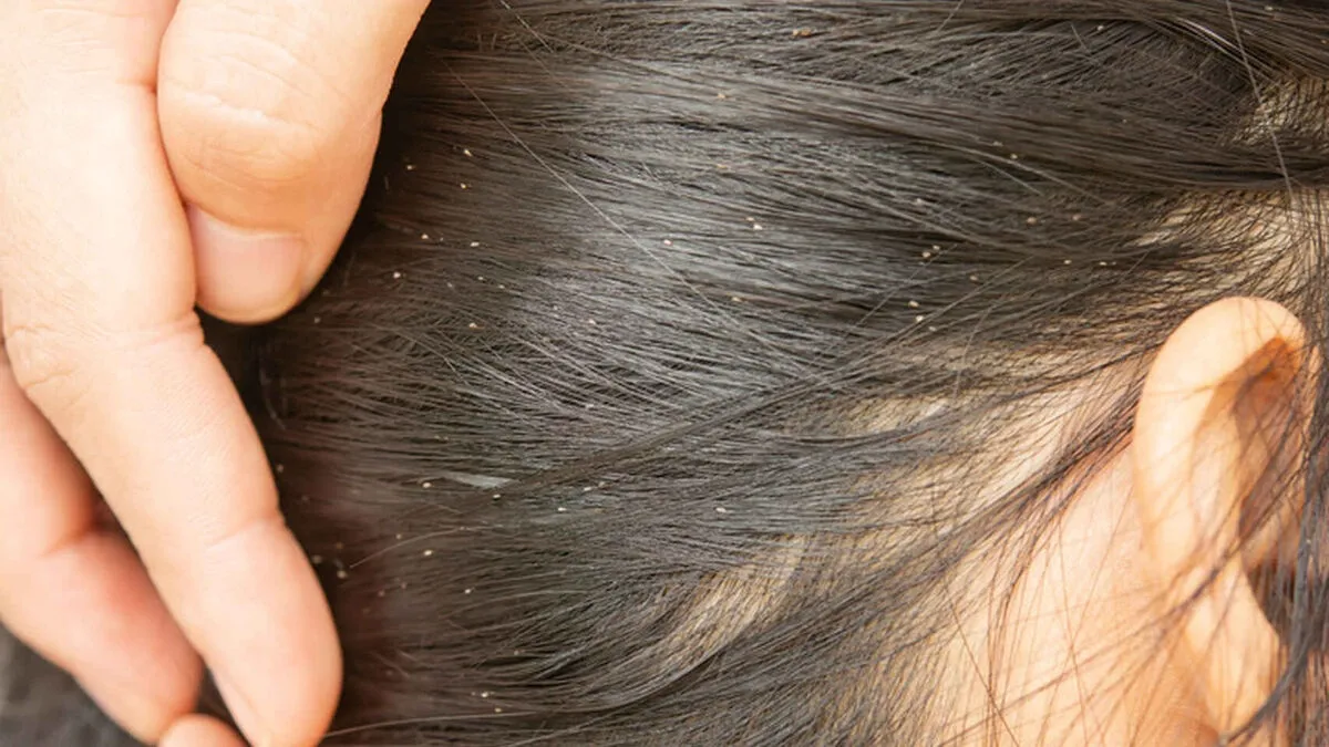 Madre vegana decide no dañar a los piojos de su hija y se los deja