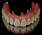 Implant Prosthesis