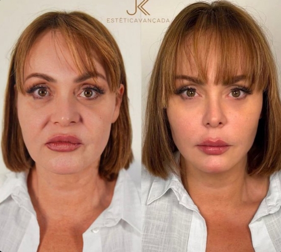 Internet Reacts After Gaby Spanic Reveals Her Facial Rejuvenation Before-And-After Transformation