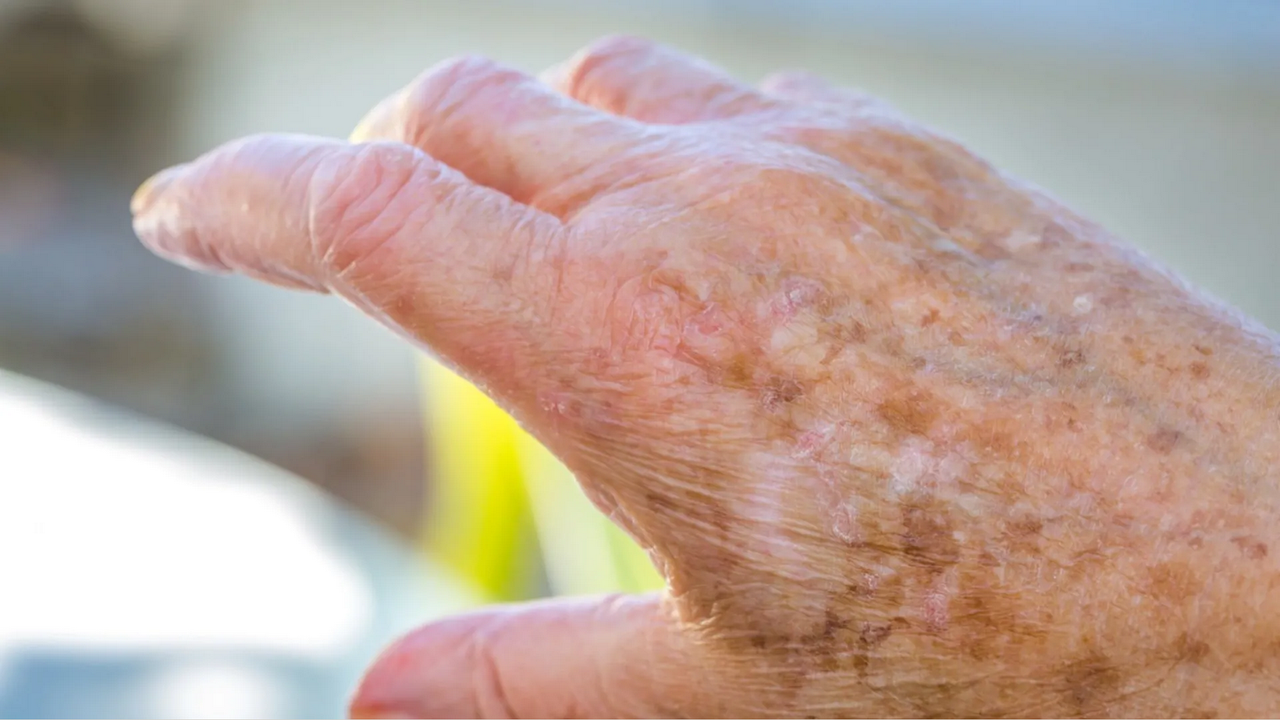 ¿Cómo quitar las manchas de las manos por la edad de forma natural?