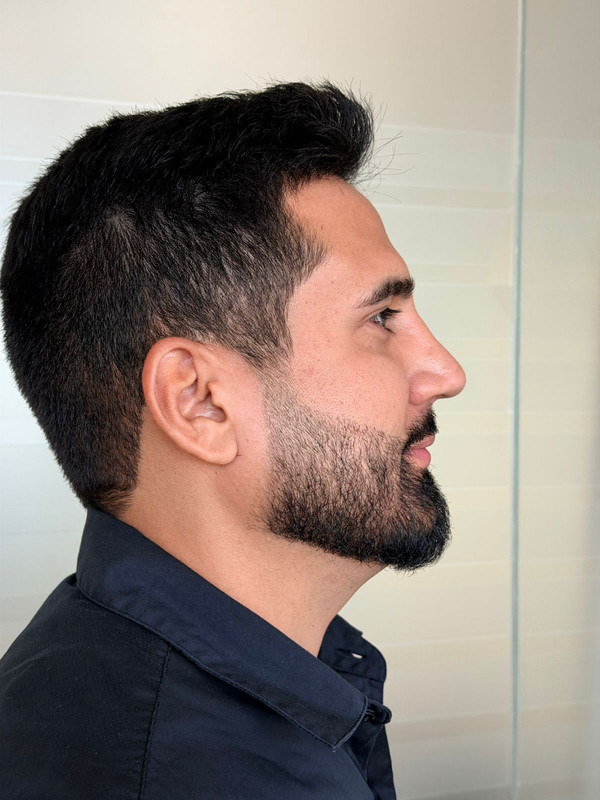 Resultado de transplante de barba 5