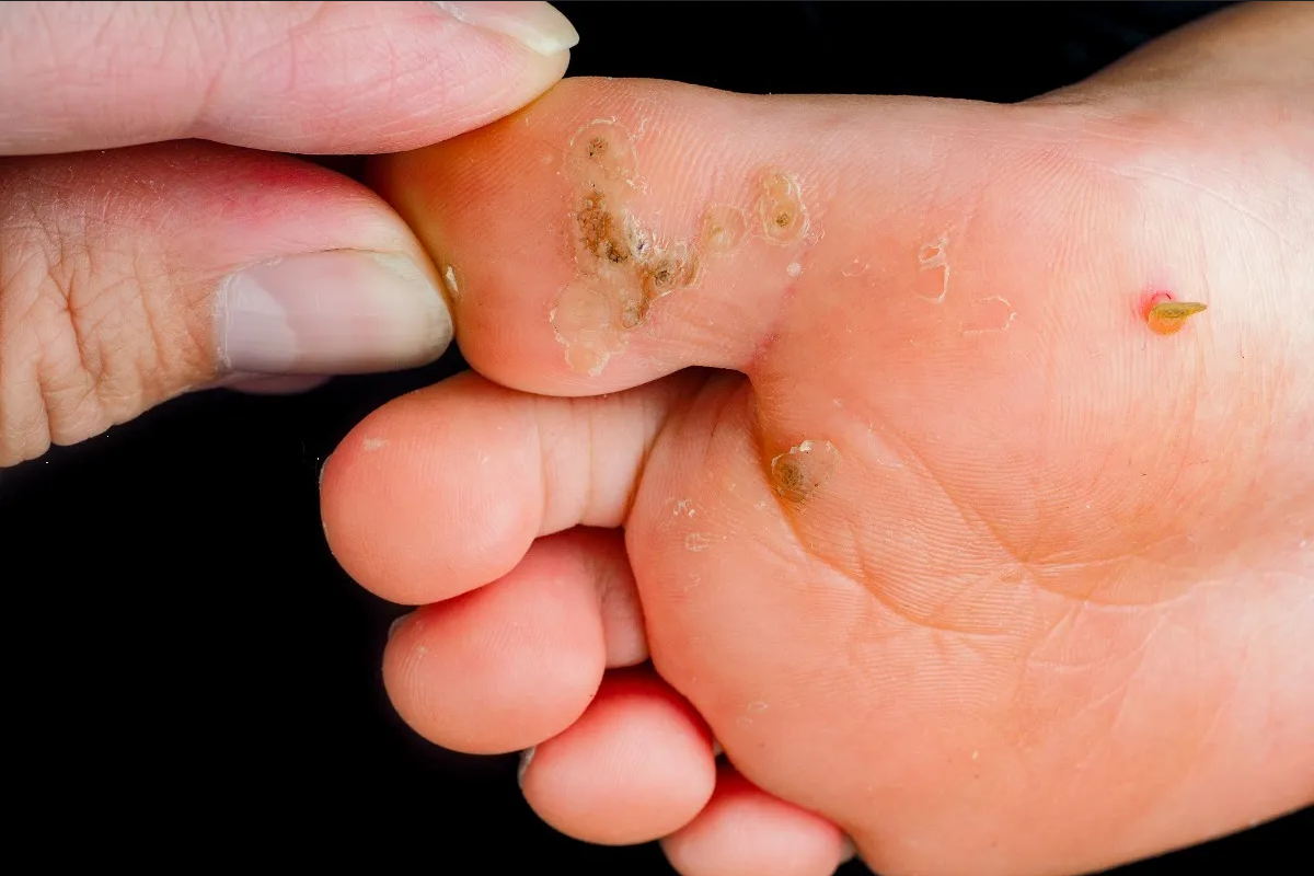 Ojos de pescado en los pies: causas, eliminación y prevención (Guía completa)