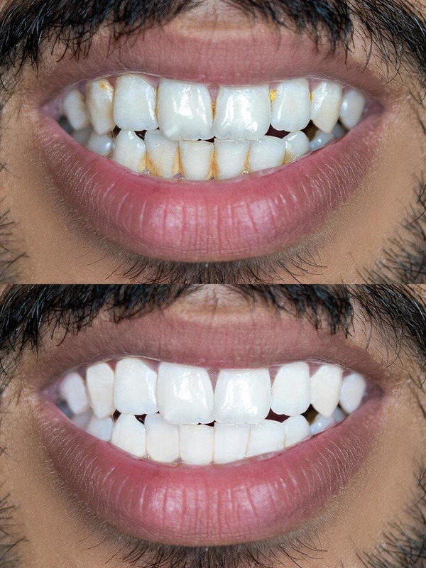 Antes e depois de um tratamento de alinhamento e clareamento dental