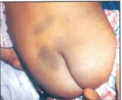 Clinical photograph showing a Mongolian spot – blue-gray macular patch on the sacrum of a neonate