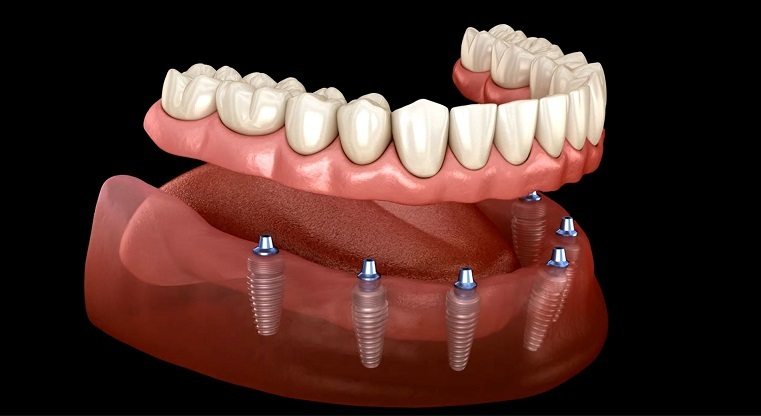 Implant Over Dentures