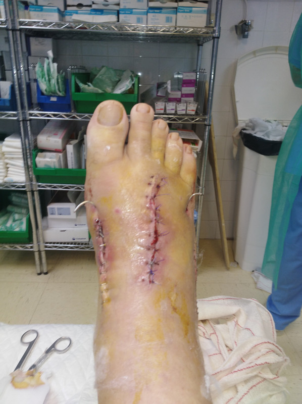 Puedo Quitarme La Bota Walker Para Dormir