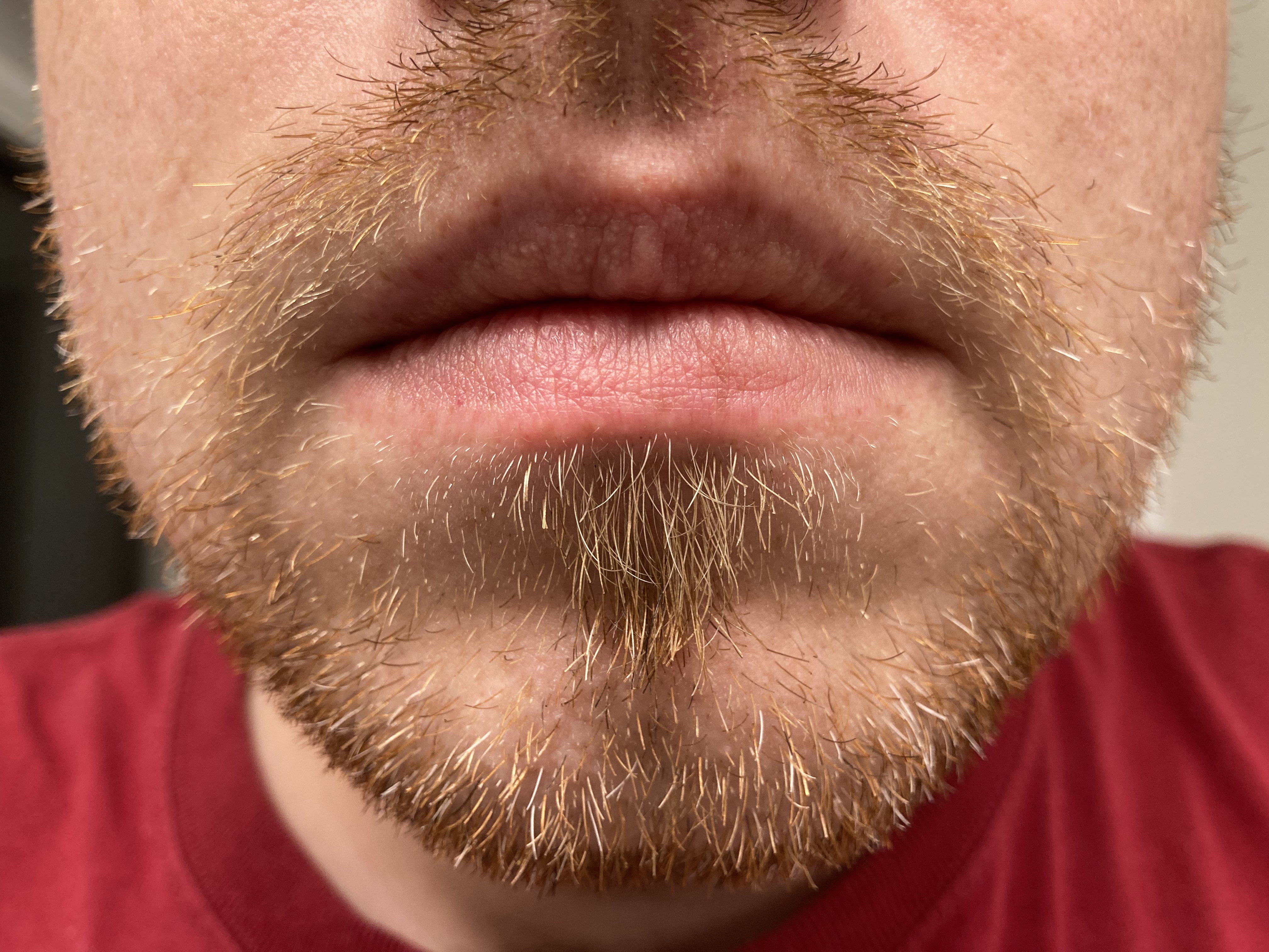 [Skin Concerns] Red Lining Under Bottom Lip What to Do? r