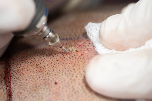 hair transplant Istanbul