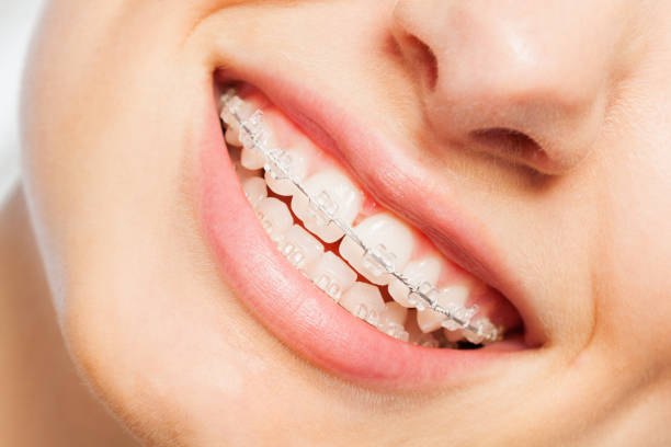 Braces Treatment Middletown New York