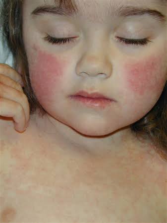 Clinical photograph showing bright red 'slapped cheek' rash on the face, characteristic of erythema infectiosum (Fifth disease) due to parvovirus B19