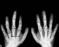 Hand X-ray showing brachydactyly with short 4th and 5th metacarpals in pseudohypoparathyroidism