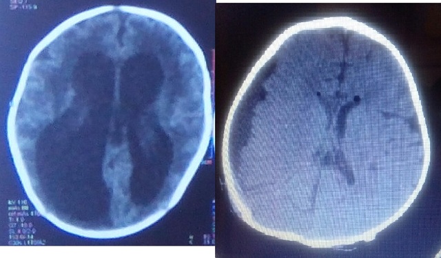 до шунта и после