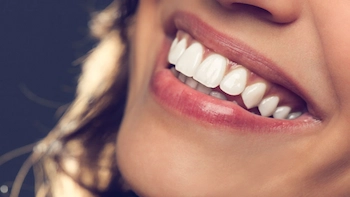 Hollywood smile