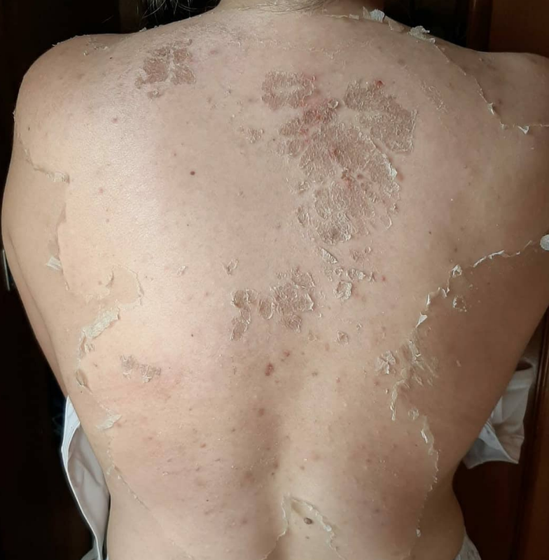 Descamacao facial pos peeling