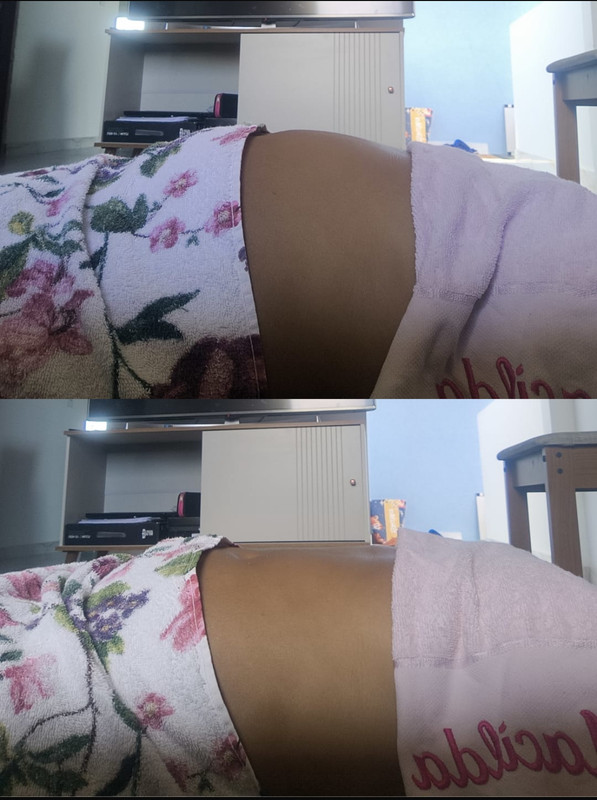 Antes e depois do tratamento de drenagem