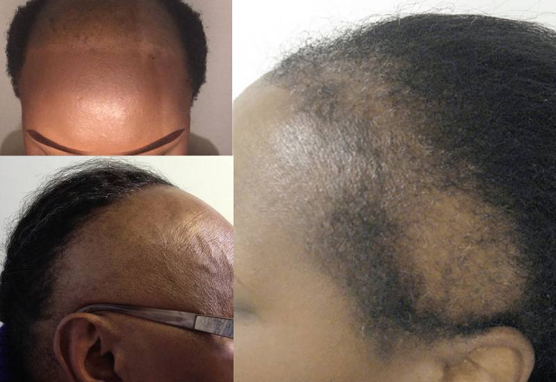 Hair loss treatment