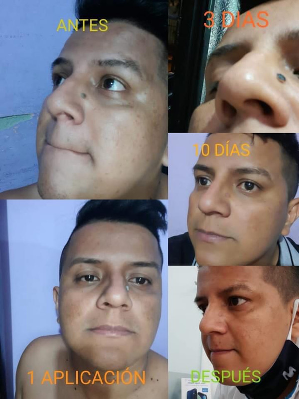 Antes y Después 2