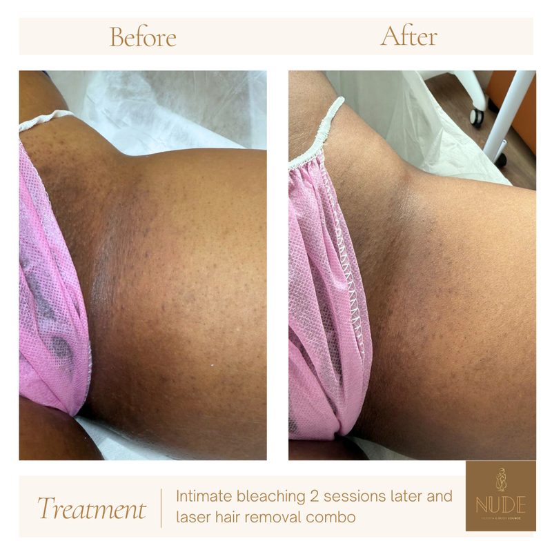 Laser Hair Removal Result