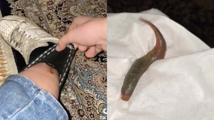 Kolase kaki Nesic yang digigit lintah berukuran lumayan besar.