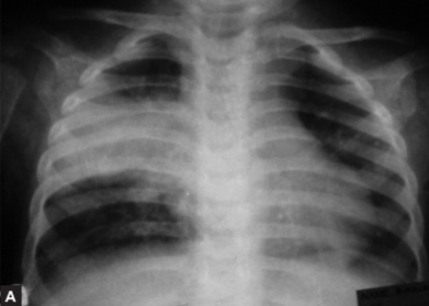 Chest X-ray Consolidation Right Superior Basal Segment – lobar pneumonia
