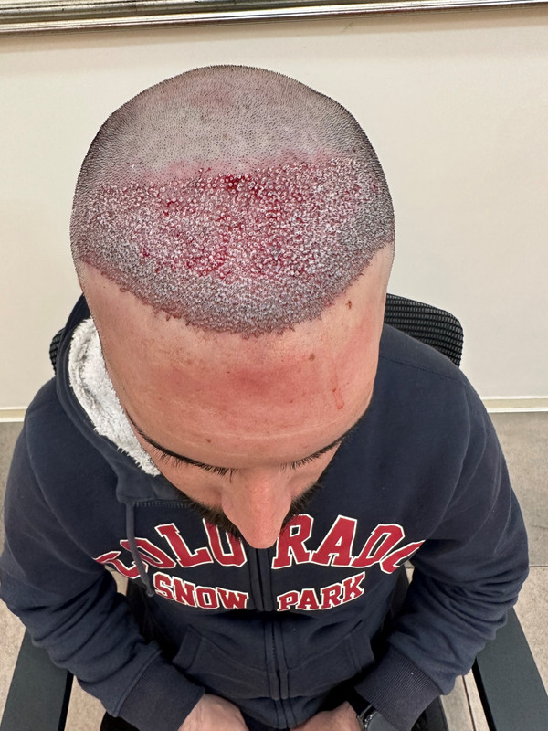 4 Post op 3460 grafts top