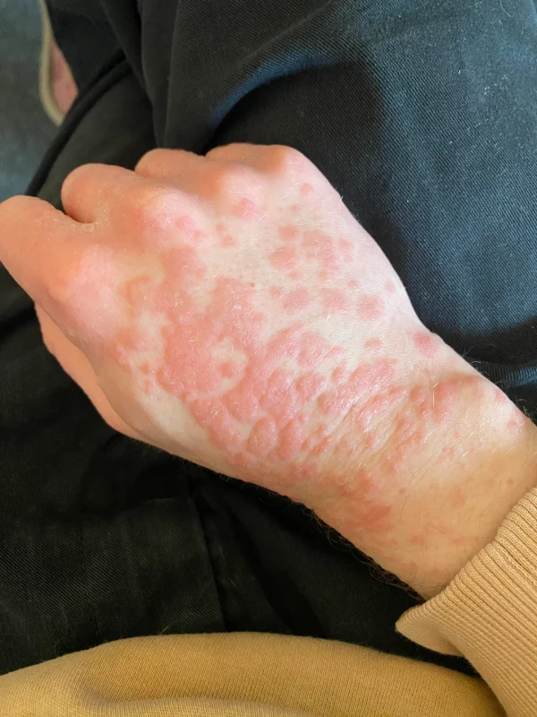 is it normal for the rash to look like this post treatment v0 r93j3a2ederg1