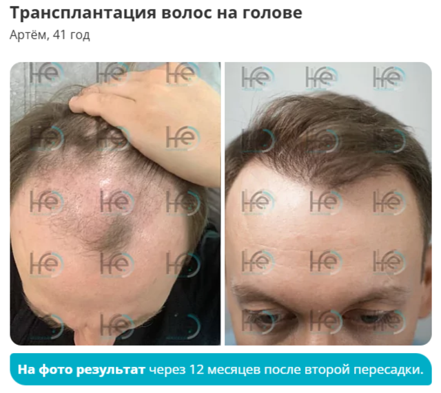пересадка волос хфе методом