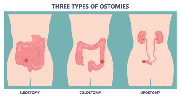 Colostomy, ileostomy, urostomy comparison chart
