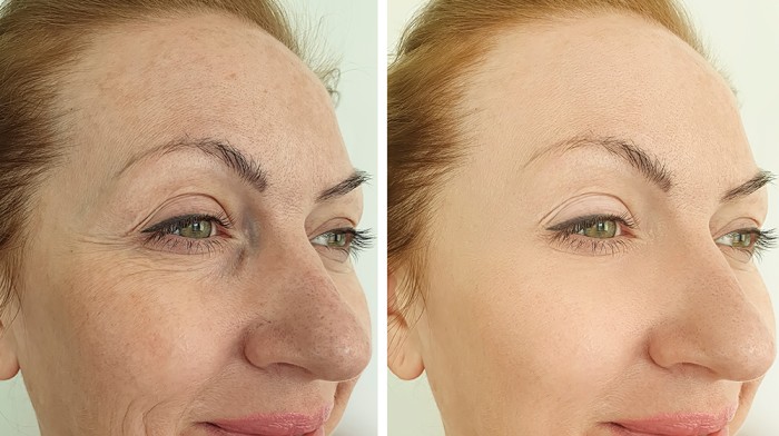 Glycolic acid before and after